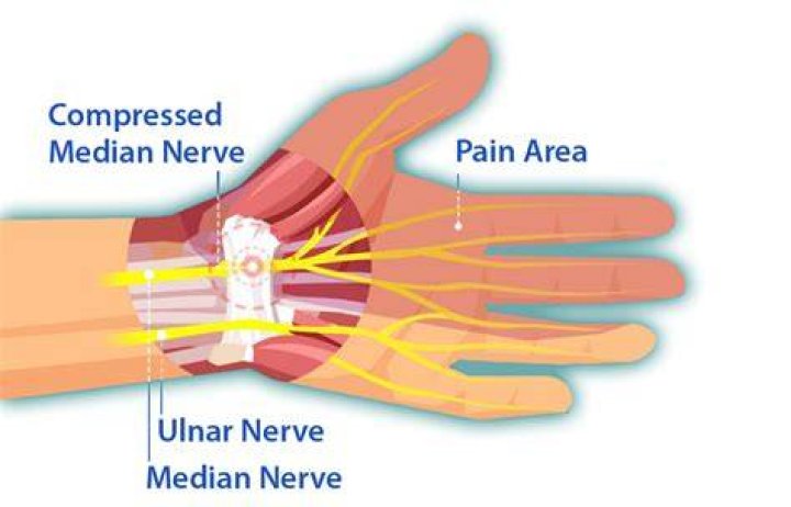 Where does your hand hurt with carpal tunnel?